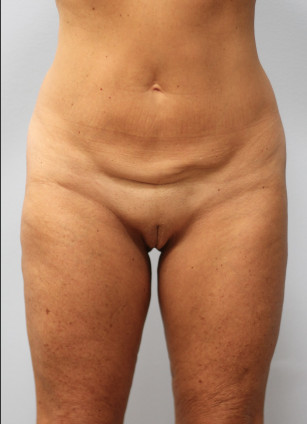 Before Image: Body Lift & SmartLipo- Dr. Howell - front