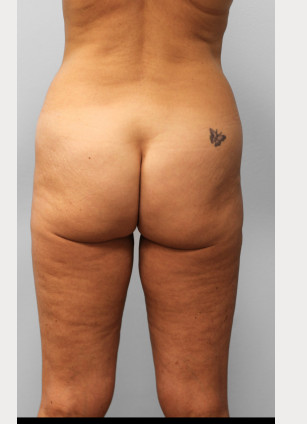 Before Image: Body Lift & SmartLipo- Dr. Howell - back
