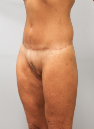 After Image: Body Lift & SmartLipo- Dr. Howell - left-front-oblique