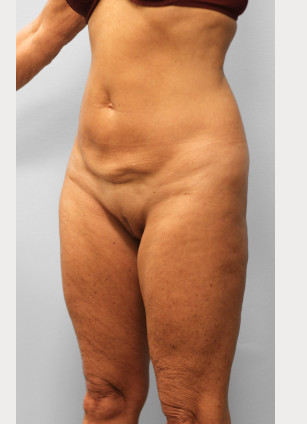 Before Image: Body Lift & SmartLipo- Dr. Howell - left-front-oblique