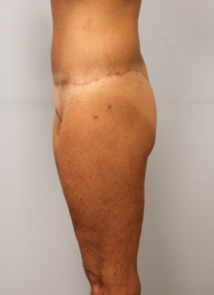 After Image: Body Lift & SmartLipo- Dr. Howell - left-side