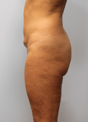 Before Image: Body Lift & SmartLipo- Dr. Howell - left-side