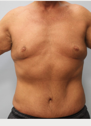 After Image: Abdominoplasty & Lipo- Dr. Howell - front