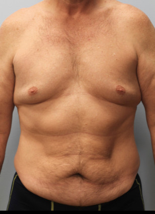 Before Image: Abdominoplasty & Lipo- Dr. Howell - front