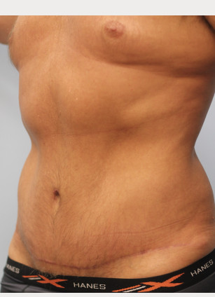 After Image: Abdominoplasty & Lipo- Dr. Howell - left-front-oblique