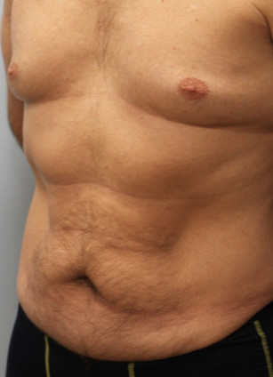 Before Image: Abdominoplasty & Lipo- Dr. Howell - left-front-oblique