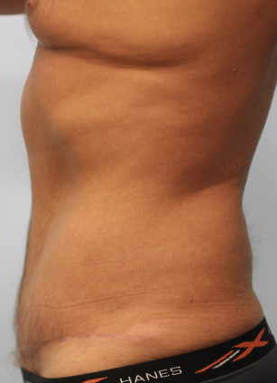 After Image: Abdominoplasty & Lipo- Dr. Howell - left-side