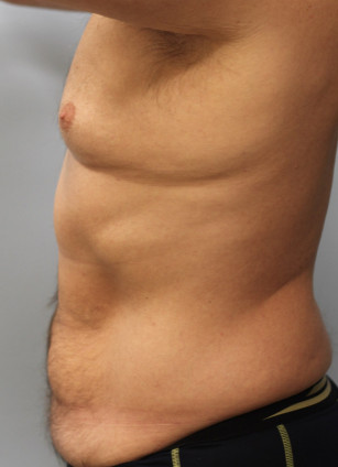 Before Image: Abdominoplasty & Lipo- Dr. Howell - left-side