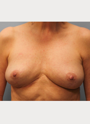 After Image: Breast Implant Revision- Dr. Howell - front