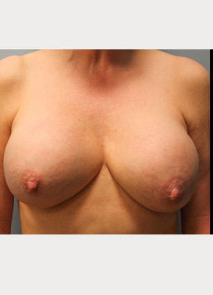 Before Image: Breast Implant Revision- Dr. Howell - front