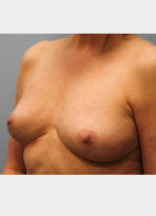 After Image: Breast Implant Revision- Dr. Howell - left-front-oblique