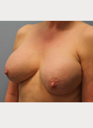 Before Image: Breast Implant Revision- Dr. Howell - left-front-oblique