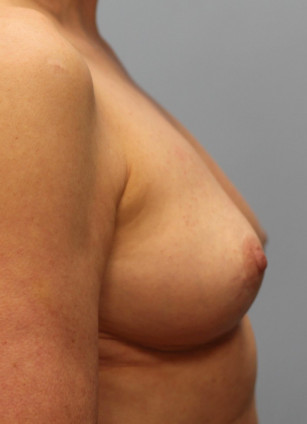 After Image: Breast Implant Revision- Dr. Howell - right-side