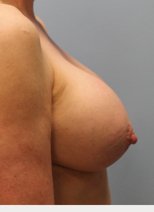 Before Image: Breast Implant Revision- Dr. Howell - right-side