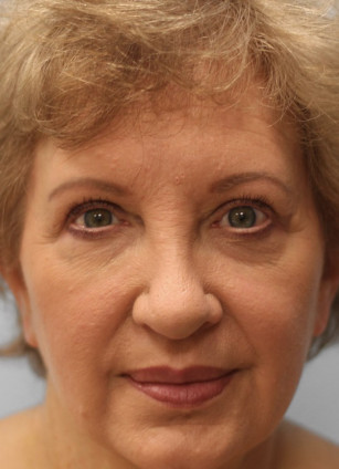 After Image: Upper Blepharoplasty- Dr. Howell - front