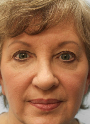 Before Image: Upper Blepharoplasty- Dr. Howell - front