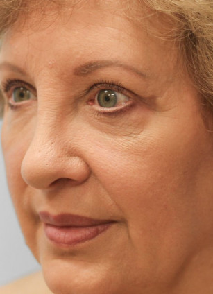 After Image: Upper Blepharoplasty- Dr. Howell - left-front-oblique