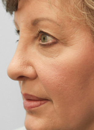 Before Image: Upper Blepharoplasty- Dr. Howell - left-front-oblique