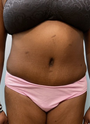After Image: Abdominoplasty & Lipo- Dr. Howell - front