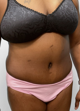 After Image: Abdominoplasty & Lipo- Dr. Howell - right-front-oblique