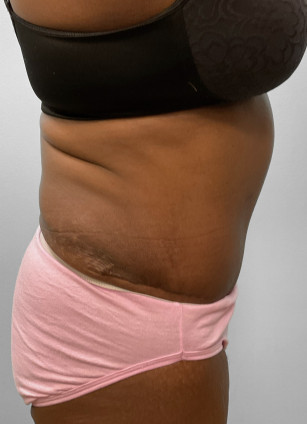 After Image: Abdominoplasty & Lipo- Dr. Howell - right-side