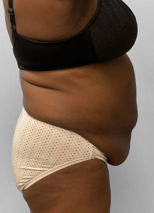 Before Image: Abdominoplasty & Lipo- Dr. Howell - right-side