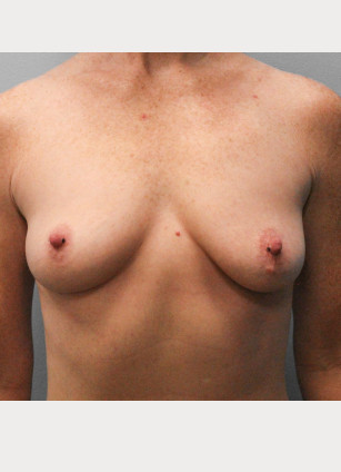 Breast Augmentation- Dr. Howell