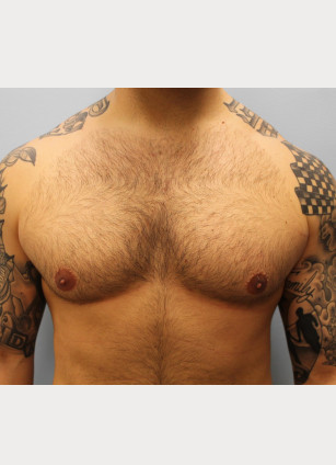 Gynecomastia- Dr. Howell