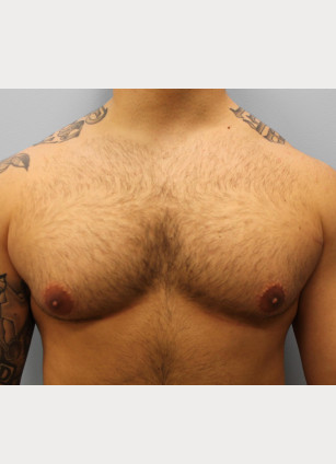 Gynecomastia- Dr. Howell