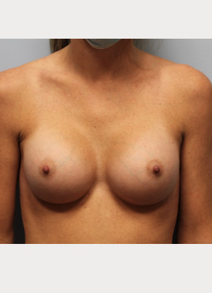 After Image: Breast Augmentation- Dr. Howell - front