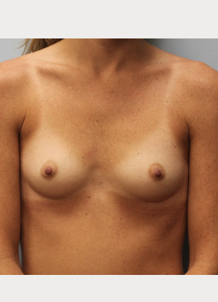 Before Image: Breast Augmentation- Dr. Howell - front