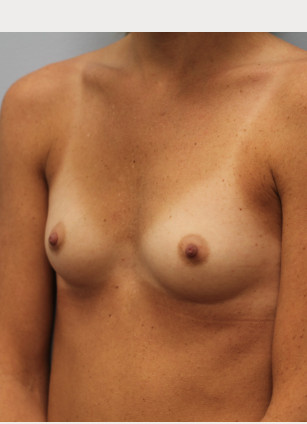 Before Image: Breast Augmentation- Dr. Howell - left-front-oblique