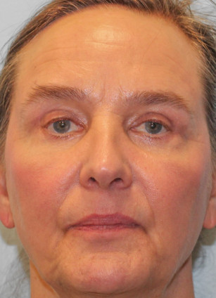 After Image: Blepharoplasty & Rhinoplasty- Dr. Howell - front