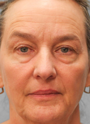 Before Image: Blepharoplasty & Rhinoplasty- Dr. Howell - front