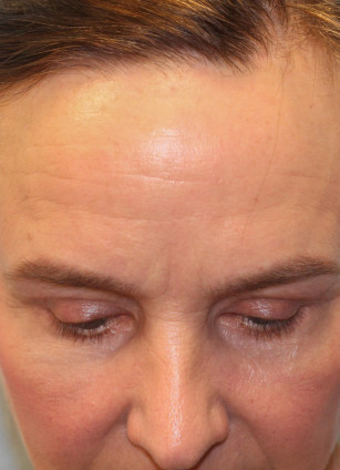 After Image: Blepharoplasty & Rhinoplasty- Dr. Howell - other