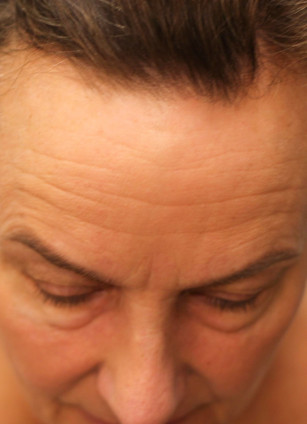 Before Image: Blepharoplasty & Rhinoplasty- Dr. Howell - other