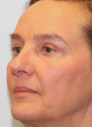 After Image: Blepharoplasty & Rhinoplasty- Dr. Howell - left-front-oblique