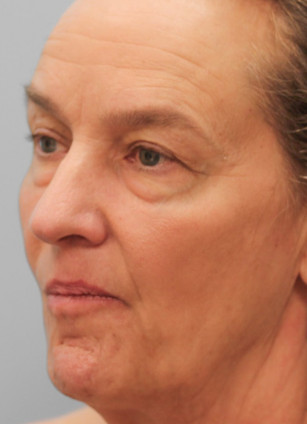 Before Image: Blepharoplasty & Rhinoplasty- Dr. Howell - left-front-oblique