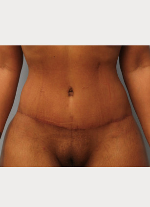 After Image: Mommy Makeover- Dr. Howell - front