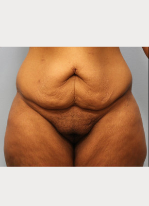 Before Image: Mommy Makeover- Dr. Howell - front