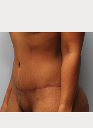 After Image: Mommy Makeover- Dr. Howell - left-front-oblique