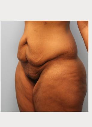 Before Image: Mommy Makeover- Dr. Howell - left-front-oblique