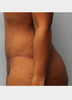 After Image: Mommy Makeover- Dr. Howell - left-side