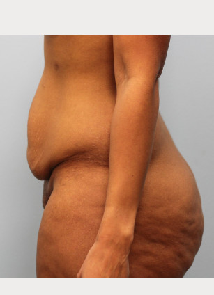 Before Image: Mommy Makeover- Dr. Howell - left-side