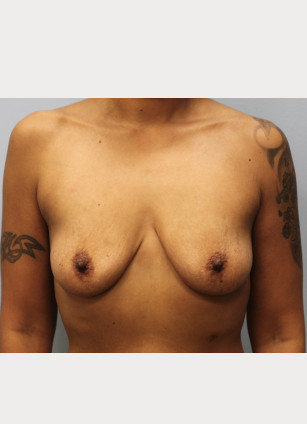 Before Image: Mommy Makeover- Dr. Howell - front
