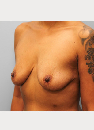 Before Image: Mommy Makeover- Dr. Howell - left-front-oblique