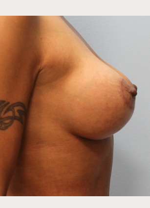 After Image: Mommy Makeover- Dr. Howell - right-side