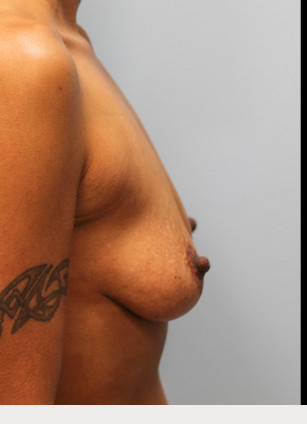 Before Image: Mommy Makeover- Dr. Howell - right-side
