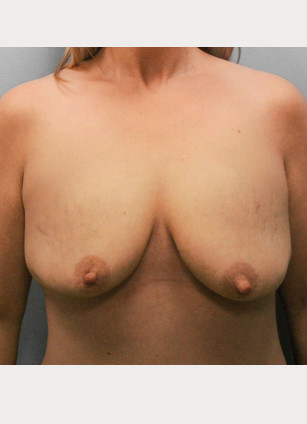 Before Image: Breast Augmentation & Lift- Dr. Howell - front