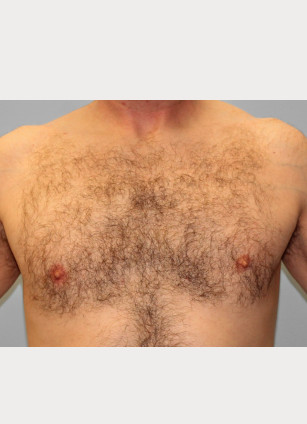 After Image: Gynecomastia & Lipo-Dr. Howell - front